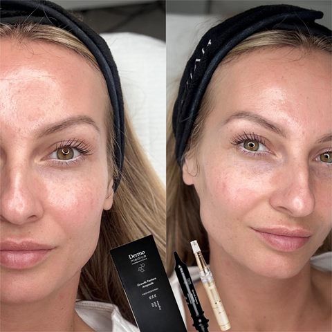Mezoterapia i peelingi